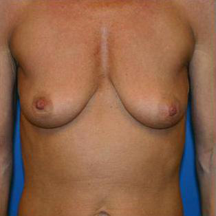 Breast Augmentation Before and After | Plastic Surgery Associates of Valdosta