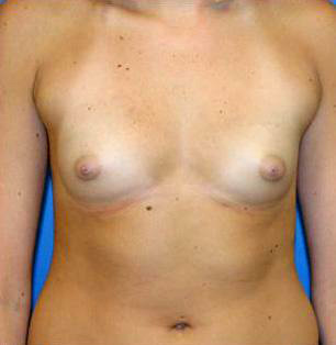 Breast Augmentation Before and After | Plastic Surgery Associates of Valdosta