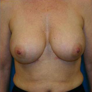 Breast Augmentation Before and After | Plastic Surgery Associates of Valdosta