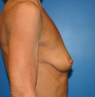 Breast Augmentation Before and After | Plastic Surgery Associates of Valdosta