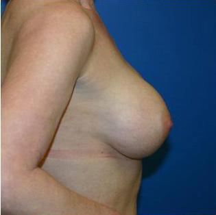 Breast Augmentation Before and After | Plastic Surgery Associates of Valdosta