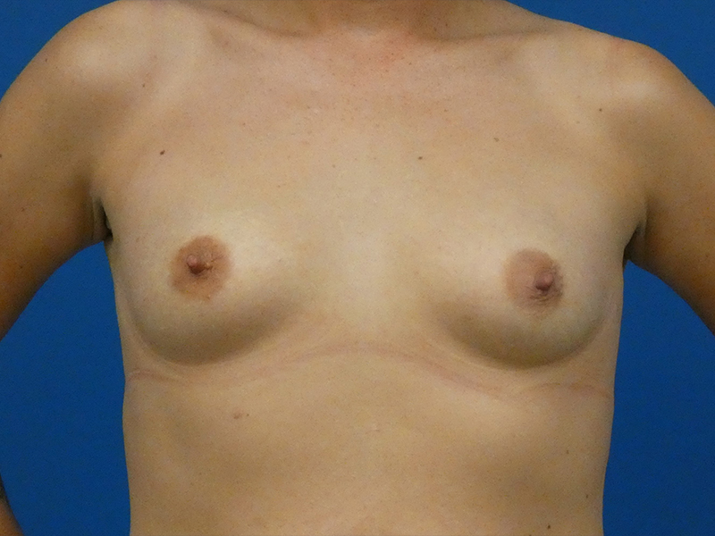 Breast Augmentation Before and After | Plastic Surgery Associates of Valdosta