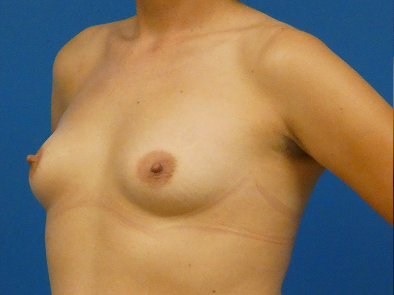 Breast Augmentation Before and After | Plastic Surgery Associates of Valdosta