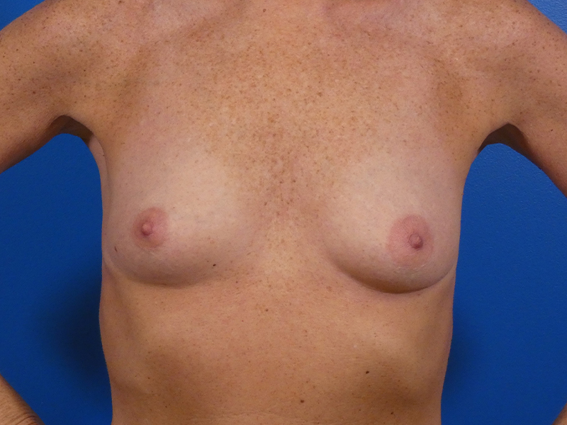 Breast Augmentation Before and After | Plastic Surgery Associates of Valdosta