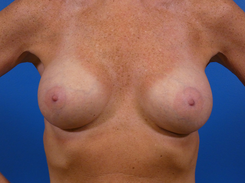 Breast Augmentation Before and After | Plastic Surgery Associates of Valdosta