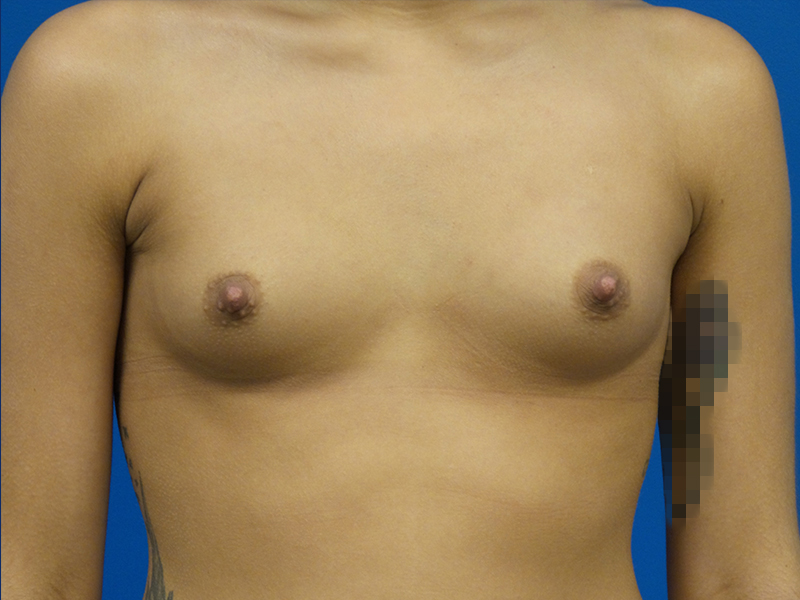 Breast Augmentation Before and After | Plastic Surgery Associates of Valdosta