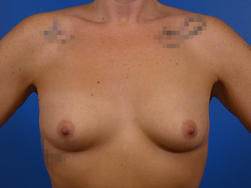 Breast Augmentation Before and After | Plastic Surgery Associates of Valdosta