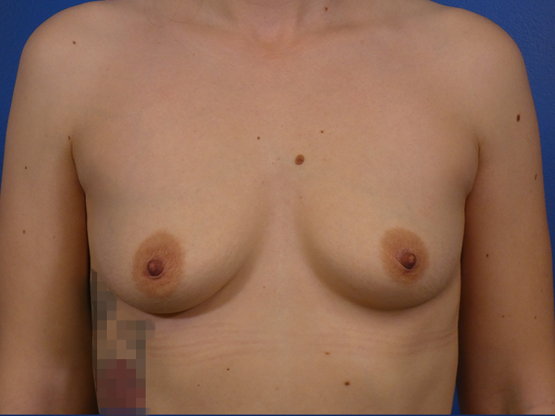 Breast Augmentation Before and After | Plastic Surgery Associates of Valdosta