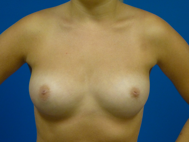 Breast Augmentation Before and After | Plastic Surgery Associates of Valdosta