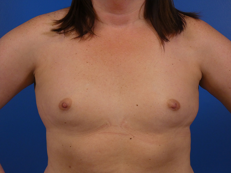 Breast Augmentation Before and After | Plastic Surgery Associates of Valdosta