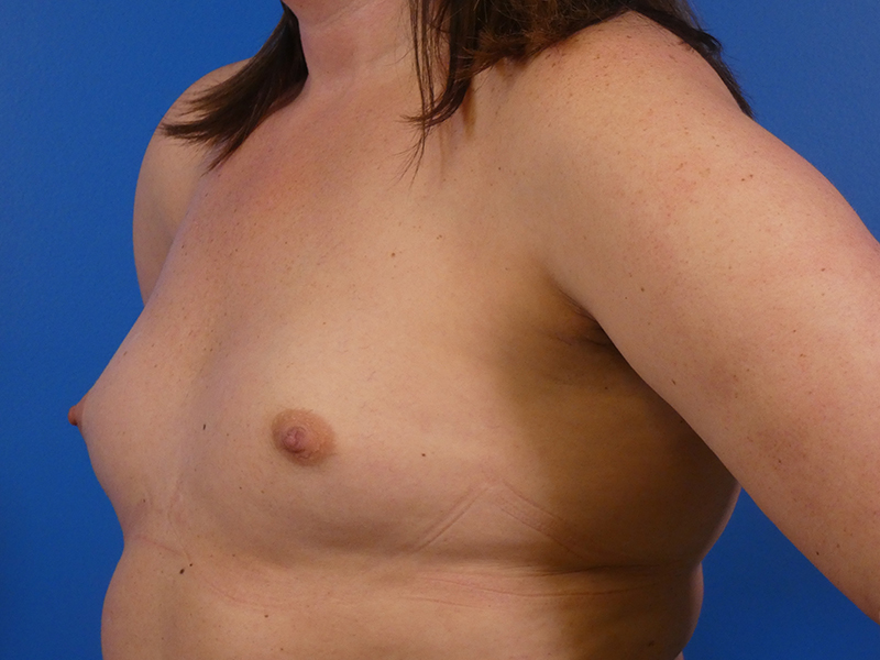 Breast Augmentation Before and After | Plastic Surgery Associates of Valdosta