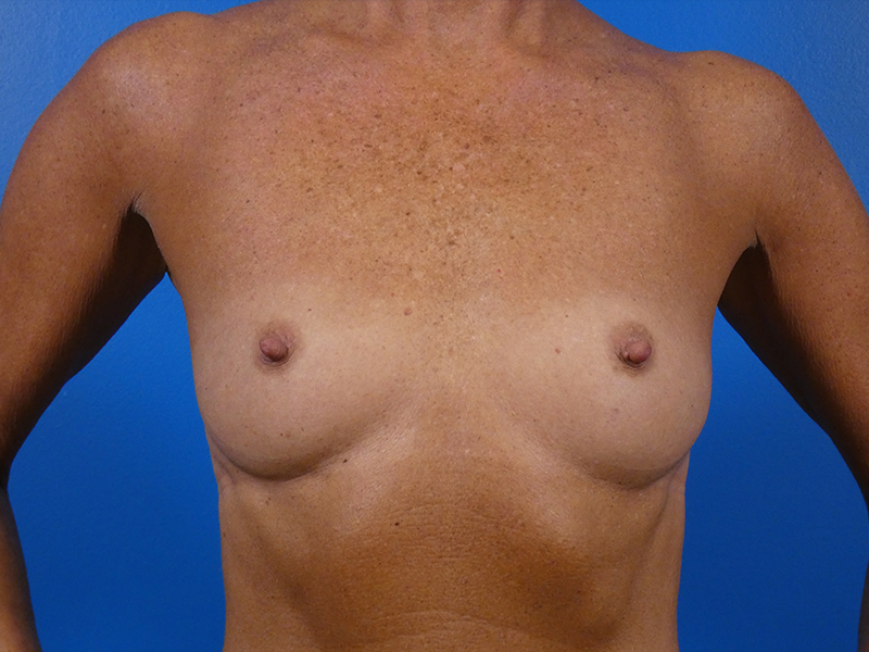 Breast Augmentation Before and After | Plastic Surgery Associates of Valdosta