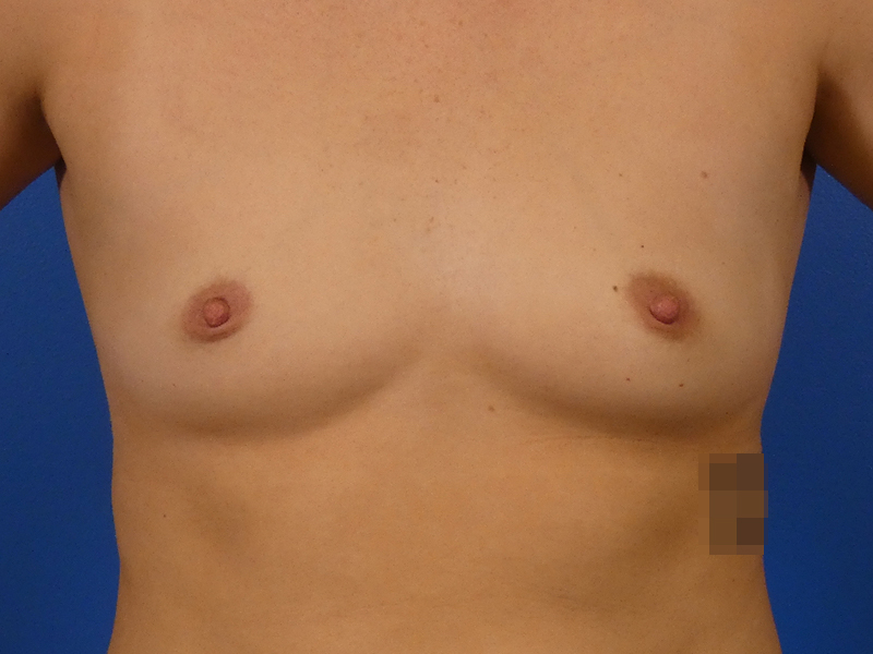 Breast Augmentation Before and After | Plastic Surgery Associates of Valdosta