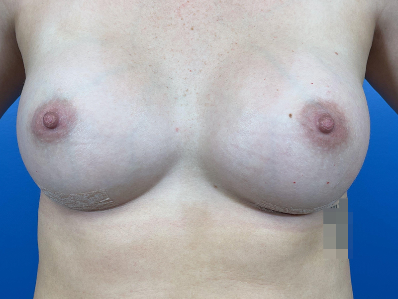 Breast Augmentation Before and After | Plastic Surgery Associates of Valdosta