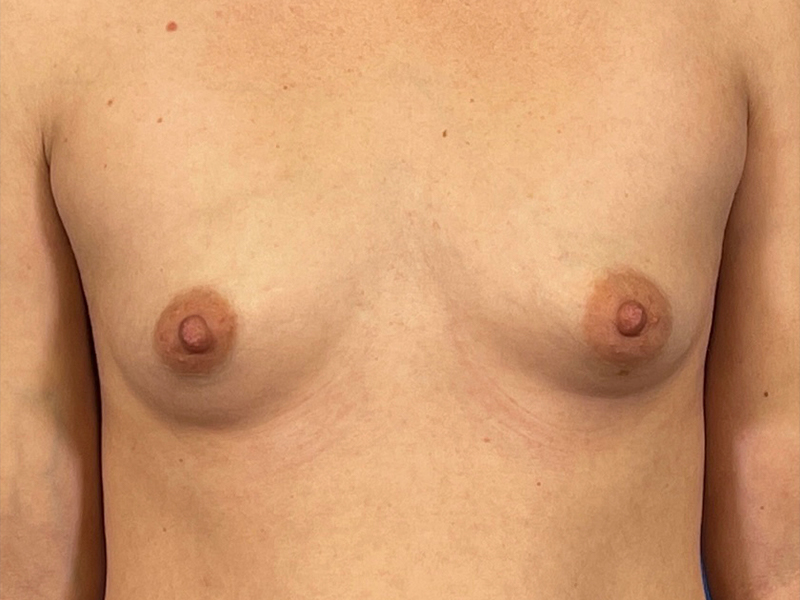 Breast Augmentation Before and After | Plastic Surgery Associates of Valdosta