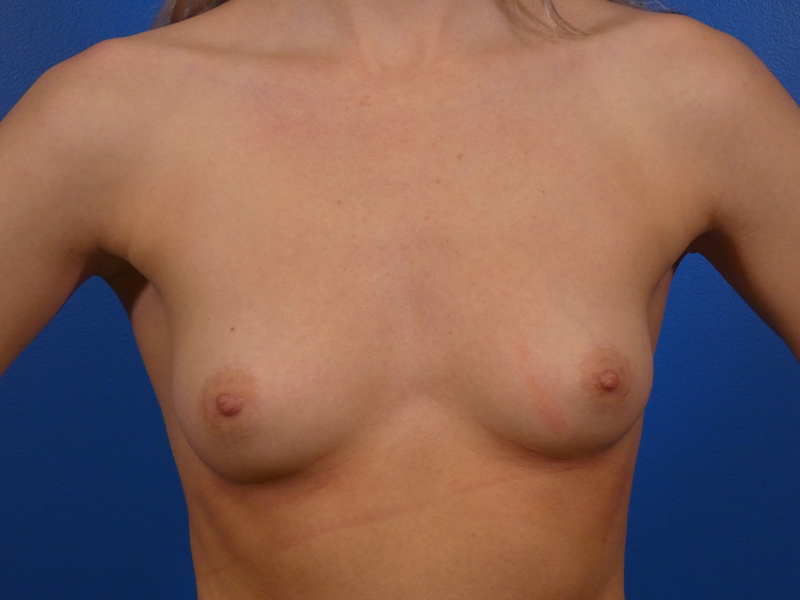 Breast Augmentation Before and After | Plastic Surgery Associates of Valdosta