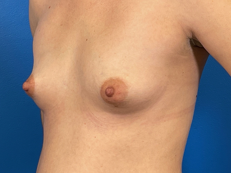 Breast Augmentation Before and After | Plastic Surgery Associates of Valdosta