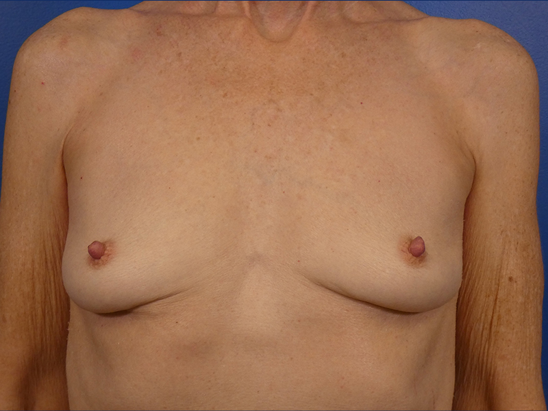 Breast Implant Removal Before and After | Plastic Surgery Associates of Valdosta