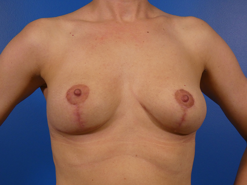 Breast Lift Before and After | Plastic Surgery Associates of Valdosta
