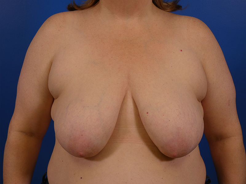 Breast Lift Before and After | Plastic Surgery Associates of Valdosta