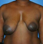 Breast Lift Before and After | Plastic Surgery Associates of Valdosta