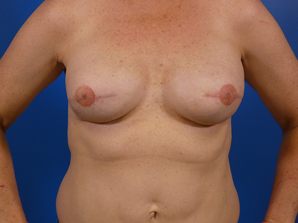 Breast Reconstruction Before and After | Plastic Surgery Associates of Valdosta