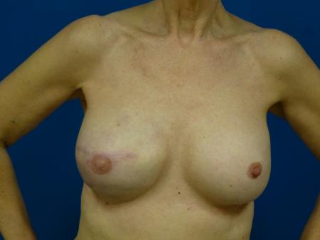 Breast Reconstruction Before and After | Plastic Surgery Associates of Valdosta