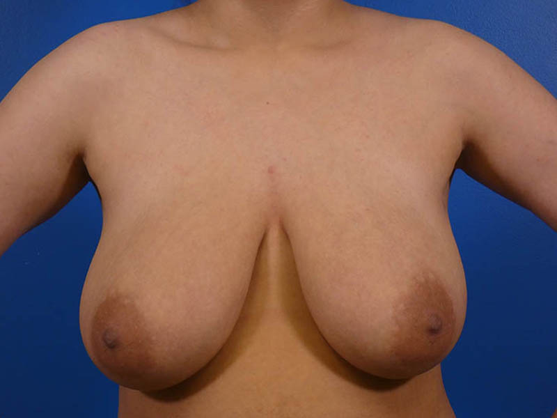 Breast Reduction Before and After | Plastic Surgery Associates of Valdosta