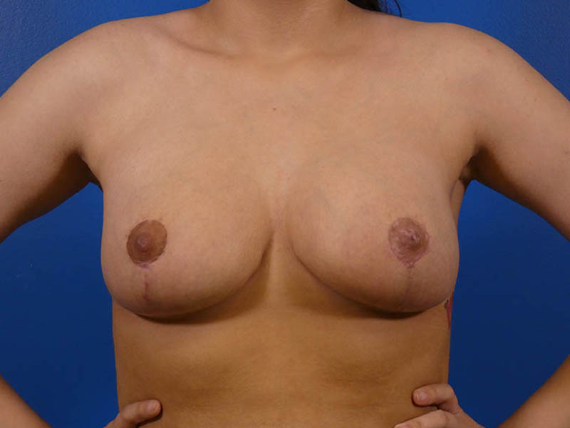 Breast Reduction Before and After | Plastic Surgery Associates of Valdosta