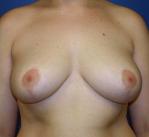 Breast Reduction Before and After | Plastic Surgery Associates of Valdosta