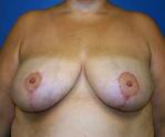 Breast Reduction Before and After | Plastic Surgery Associates of Valdosta
