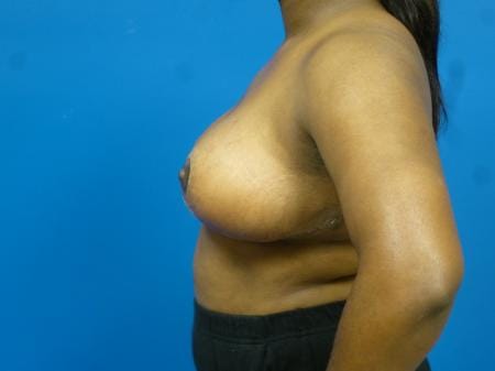 Breast Reduction Before and After | Plastic Surgery Associates of Valdosta