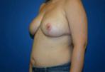 Breast Reduction Before and After | Plastic Surgery Associates of Valdosta