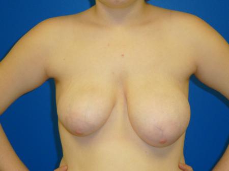 Breast Reduction Before and After | Plastic Surgery Associates of Valdosta