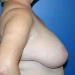 Breast Reduction Before and After | Plastic Surgery Associates of Valdosta