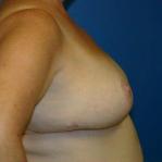 Breast Reduction Before and After | Plastic Surgery Associates of Valdosta