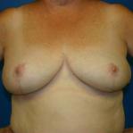 Breast Reduction Before and After | Plastic Surgery Associates of Valdosta