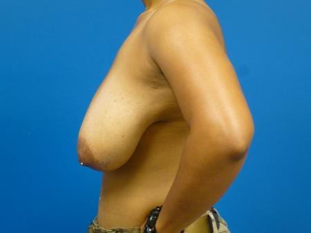 Breast Reduction Before and After | Plastic Surgery Associates of Valdosta