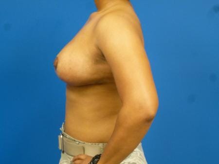 Breast Reduction Before and After | Plastic Surgery Associates of Valdosta