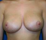 Breast Reduction Before and After | Plastic Surgery Associates of Valdosta