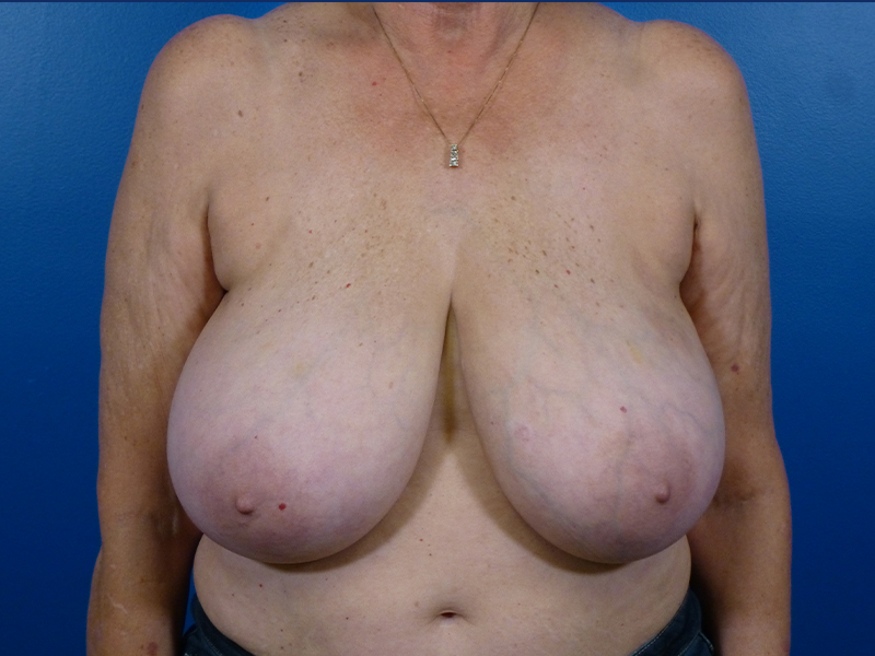 Breast Reduction Before and After | Plastic Surgery Associates of Valdosta