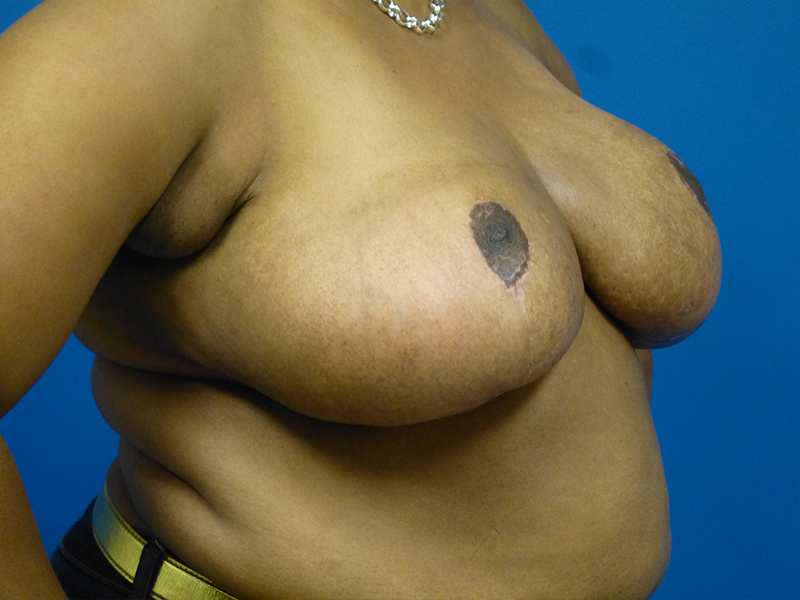 Breast Reduction Before and After | Plastic Surgery Associates of Valdosta