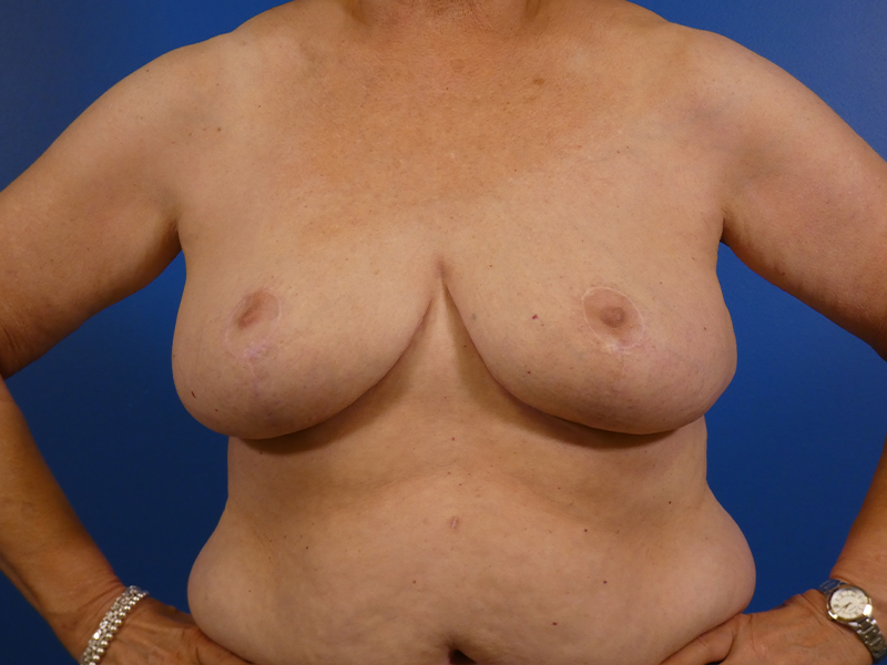 Breast Reduction Before and After | Plastic Surgery Associates of Valdosta