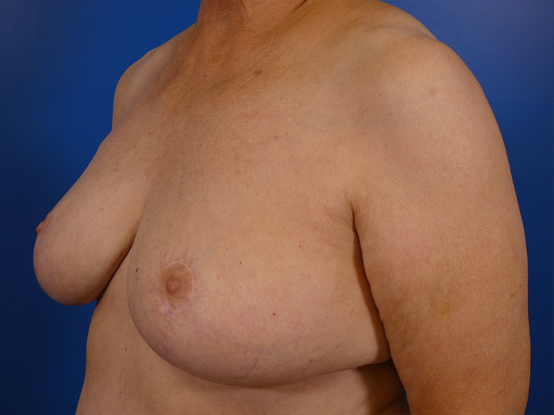 Breast Reduction Before and After | Plastic Surgery Associates of Valdosta