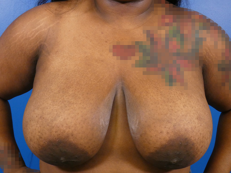Breast Reduction Before and After | Plastic Surgery Associates of Valdosta