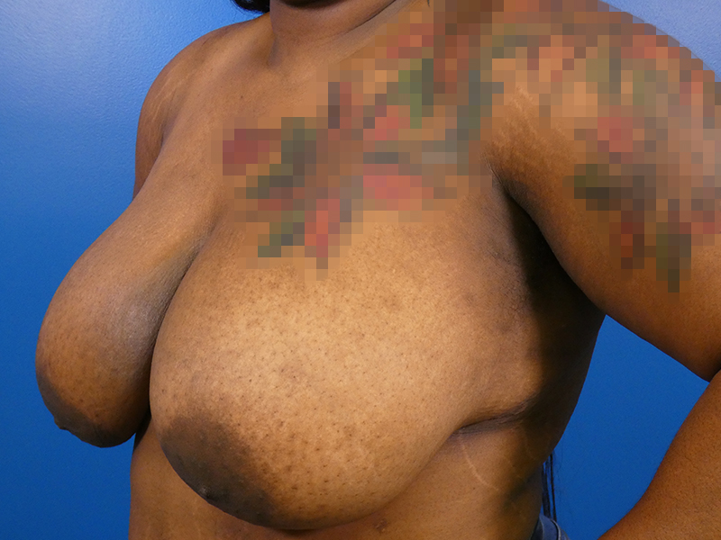 Breast Reduction Before and After | Plastic Surgery Associates of Valdosta