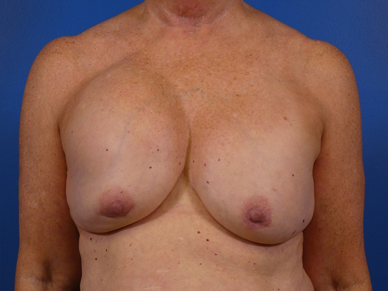 Breast Revision Before and After | Plastic Surgery Associates of Valdosta