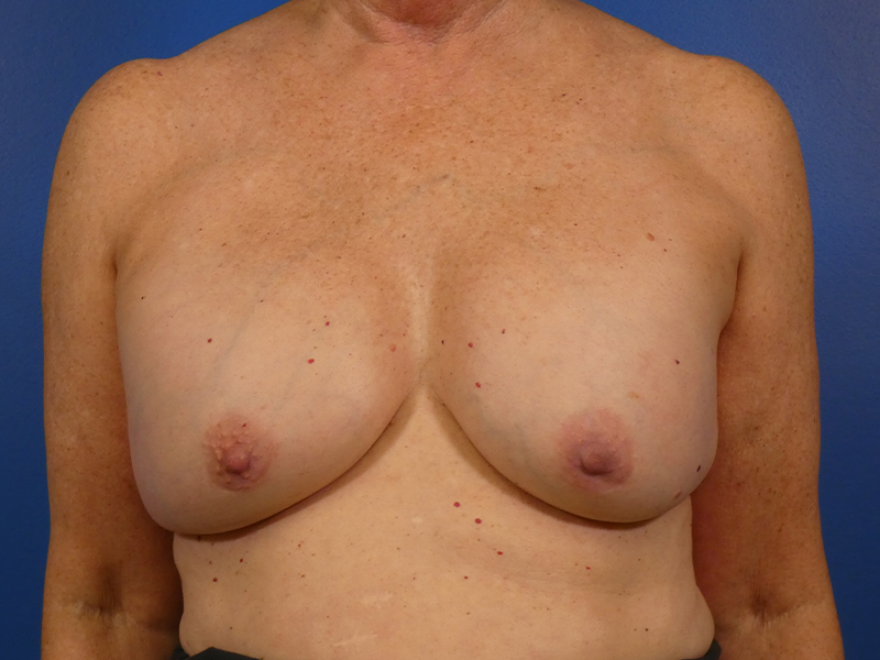 Breast Revision Before and After | Plastic Surgery Associates of Valdosta