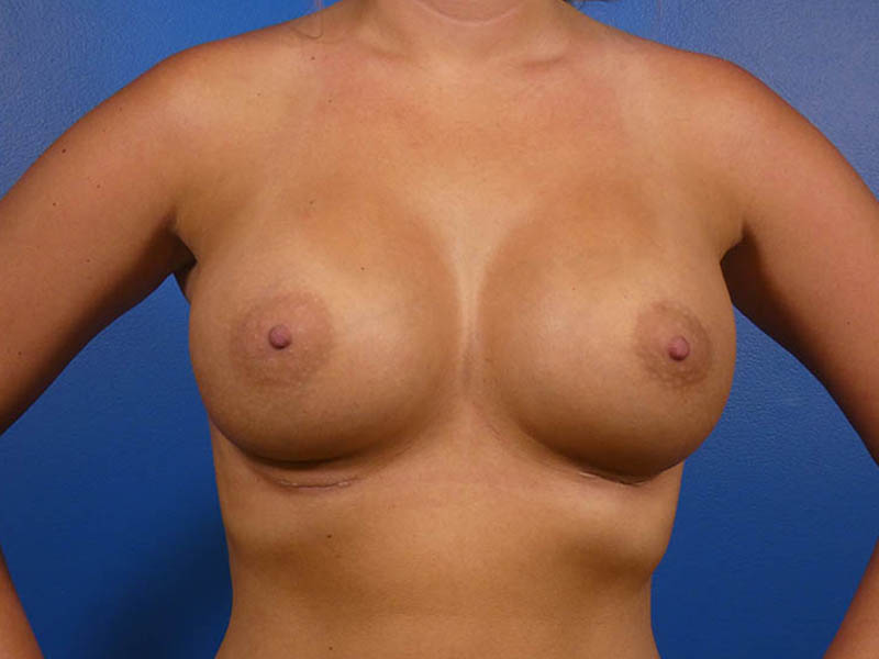Breast Revision Before and After | Plastic Surgery Associates of Valdosta