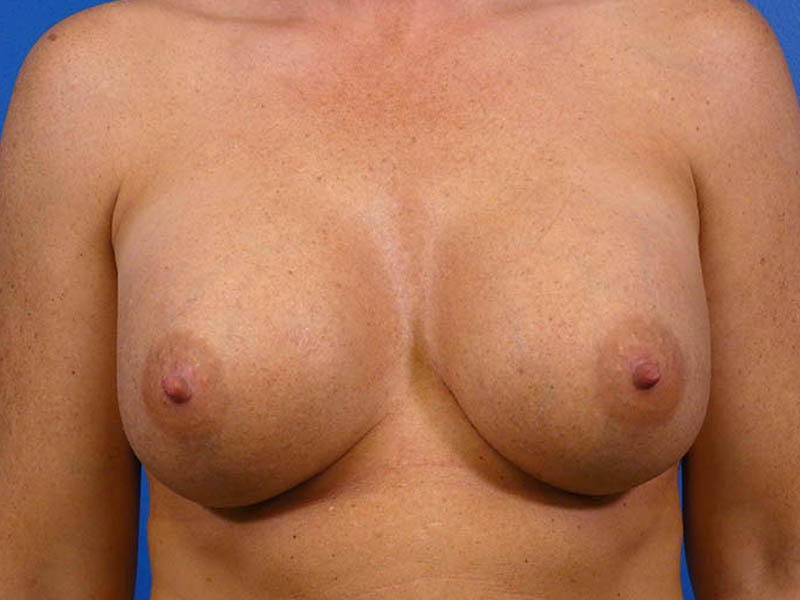 Breast Revision Before and After | Plastic Surgery Associates of Valdosta